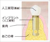 �C���v�����g